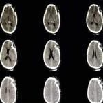 CT scan of a skull traumatic brain injury 