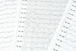 EEG electrophysiological monitoring method. EEG wave in human brain, Brain wave patterns on electroencephalogram, EEG of the child, detect problems in the electrical activity of the brain